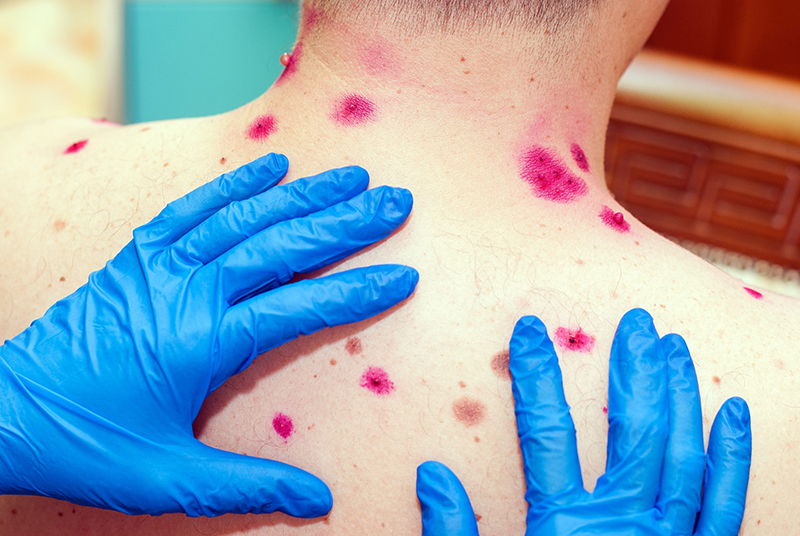 Mpox, varíola e monkeypox: qual é a diferença?